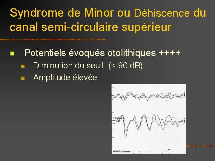 Syndrome de Minor ou Déhiscence du canal semi-circulaire supérieur n Potentiels évoqués otolithiques ++++