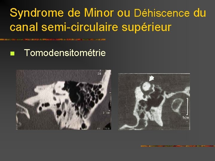 Syndrome de Minor ou Déhiscence du canal semi-circulaire supérieur n Tomodensitométrie 