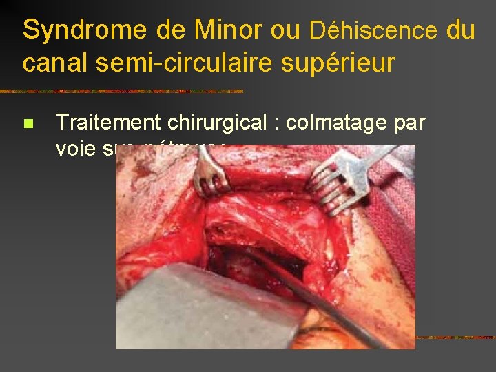 Syndrome de Minor ou Déhiscence du canal semi-circulaire supérieur n Traitement chirurgical : colmatage