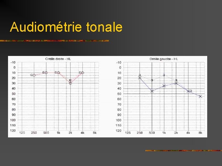 Audiométrie tonale 
