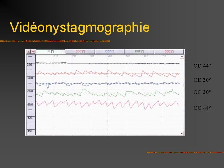 Vidéonystagmographie OD 44° OD 30° OG 44° 