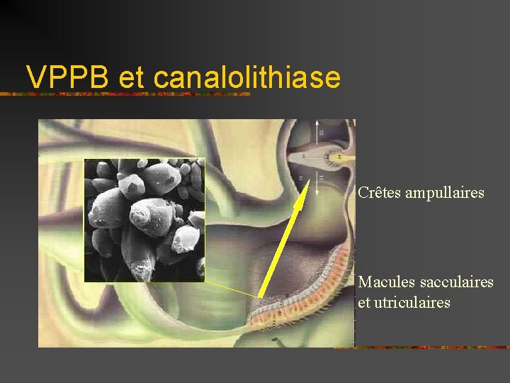 VPPB et canalolithiase Crêtes ampullaires Macules sacculaires et utriculaires 