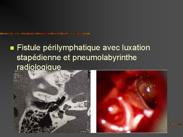 n Fistule périlymphatique avec luxation stapédienne et pneumolabyrinthe radiologique 