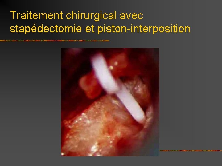 Traitement chirurgical avec stapédectomie et piston-interposition 