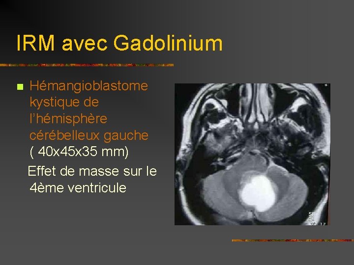IRM avec Gadolinium Hémangioblastome kystique de l’hémisphère cérébelleux gauche ( 40 x 45 x