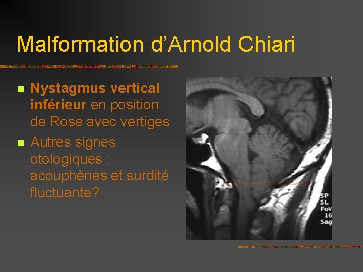 Malformation d’Arnold Chiari n n Nystagmus vertical inférieur en position de Rose avec vertiges