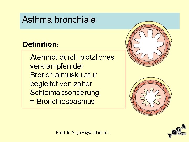 Asthma bronchiale Definition: Atemnot durch plötzliches verkrampfen der Bronchialmuskulatur begleitet von zäher Schleimabsonderung. =