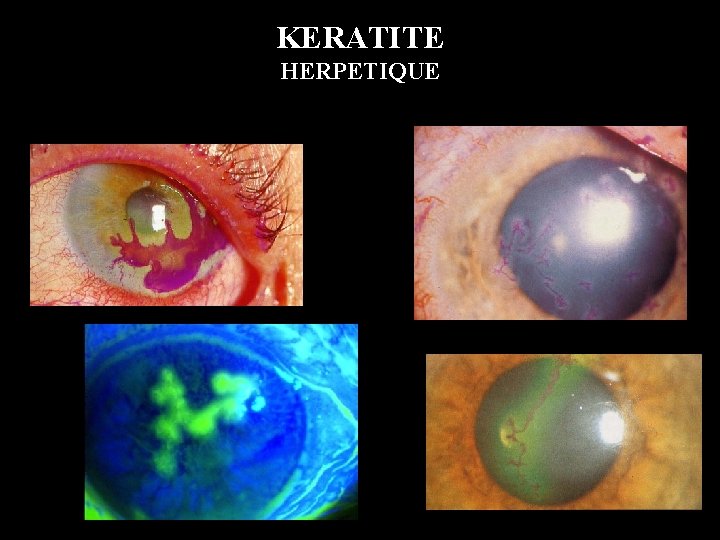KERATITE HERPETIQUE 