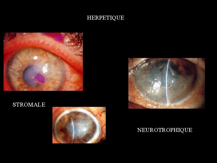 HERPETIQUE STROMALE NEUROTROPHIQUE 