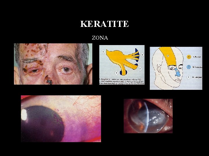 KERATITE ZONA 