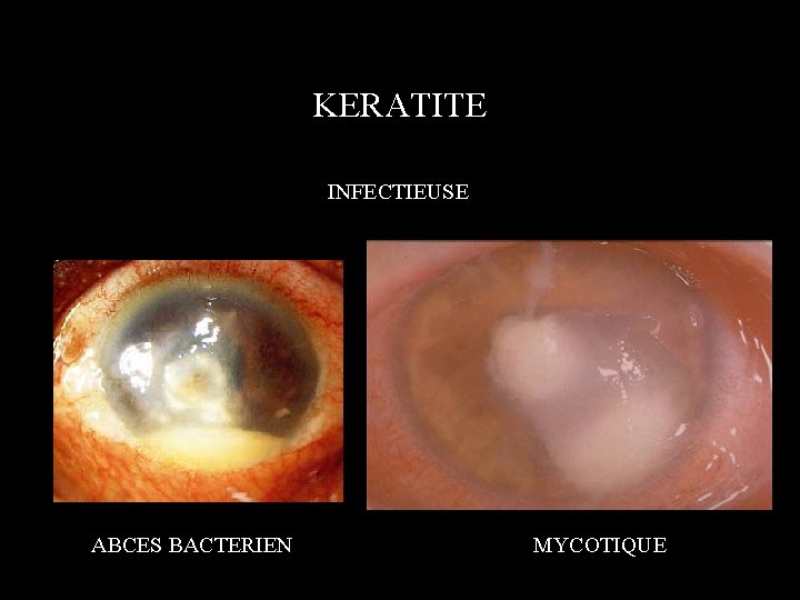 KERATITE INFECTIEUSE ABCES BACTERIEN MYCOTIQUE 