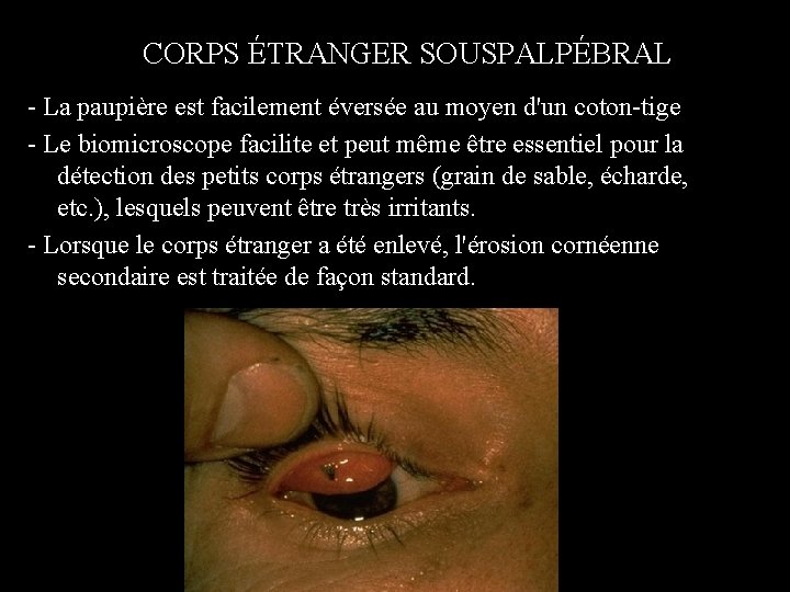 CORPS ÉTRANGER SOUSPALPÉBRAL - La paupière est facilement éversée au moyen d'un coton-tige -