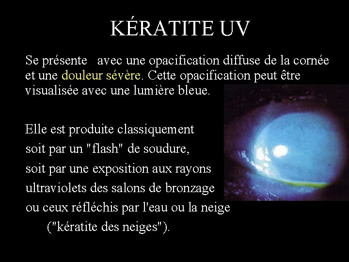 KÉRATITE UV Se présente avec une opacification diffuse de la cornée et une douleur