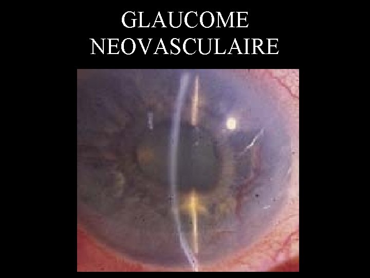 GLAUCOME NEOVASCULAIRE 