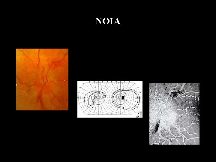 NOIA 