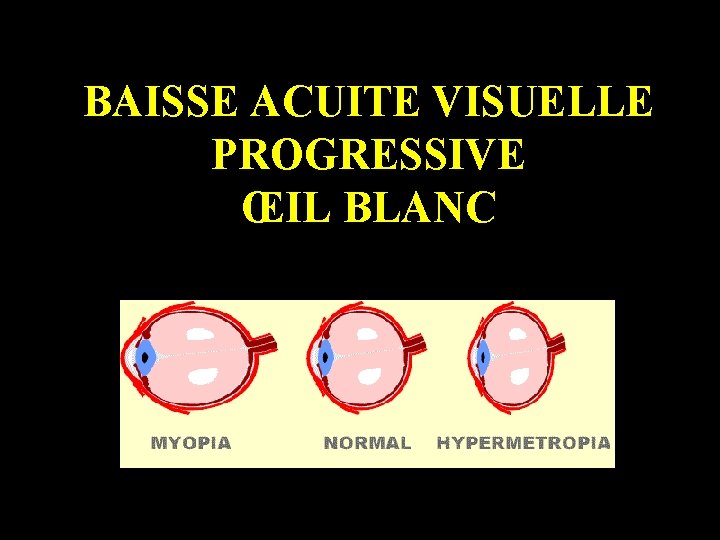 BAISSE ACUITE VISUELLE PROGRESSIVE ŒIL BLANC 