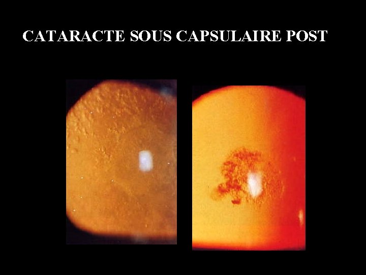 CATARACTE SOUS CAPSULAIRE POST 