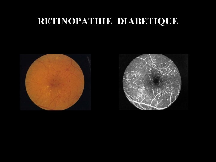 RETINOPATHIE DIABETIQUE 