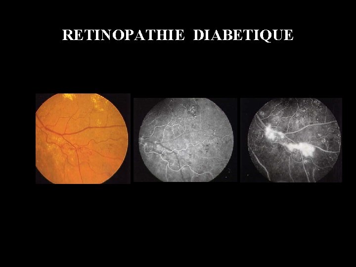 RETINOPATHIE DIABETIQUE 