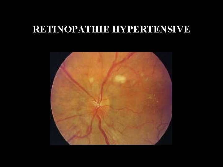 RETINOPATHIE HYPERTENSIVE 