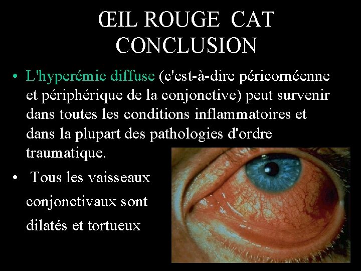 ŒIL ROUGE CAT CONCLUSION • L'hyperémie diffuse (c'est-à-dire péricornéenne et périphérique de la conjonctive)