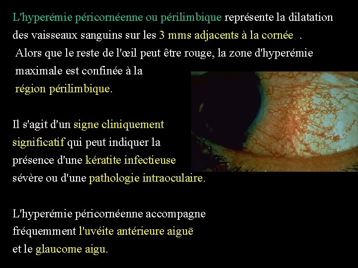 L'hyperémie péricornéenne ou périlimbique représente la dilatation des vaisseaux sanguins sur les 3 mms