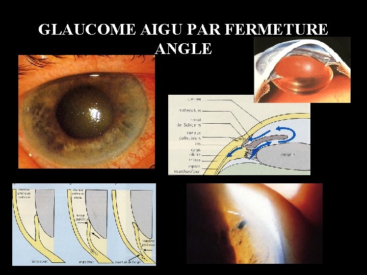 GLAUCOME AIGU PAR FERMETURE ANGLE 