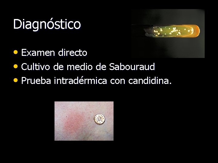 Diagnóstico • Examen directo • Cultivo de medio de Sabouraud • Prueba intradérmica con