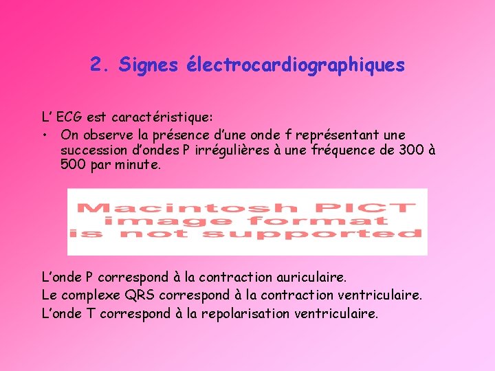 2. Signes électrocardiographiques L’ ECG est caractéristique: • On observe la présence d’une onde