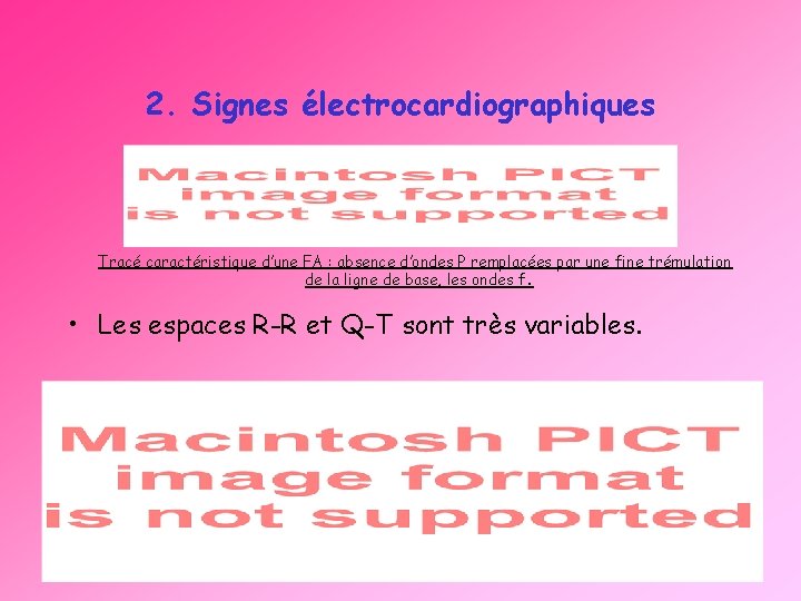 2. Signes électrocardiographiques Tracé caractéristique d’une FA : absence d’ondes P remplacées par une