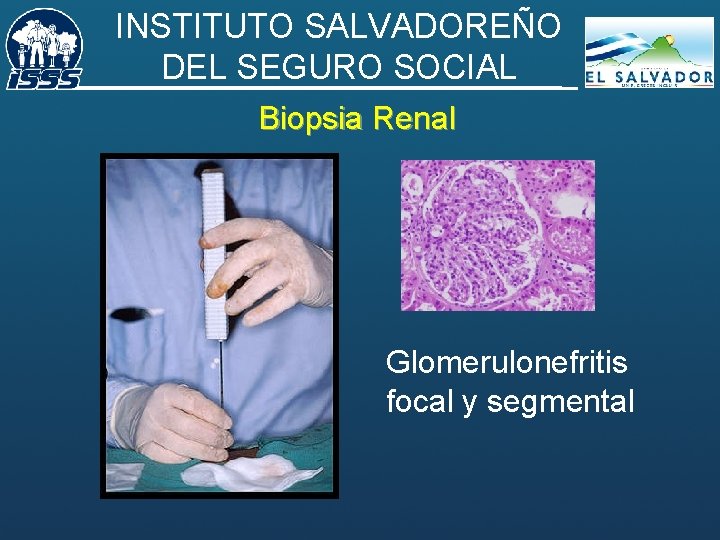 INSTITUTO SALVADOREÑO DEL SEGURO SOCIAL Biopsia Renal Glomerulonefritis focal y segmental 