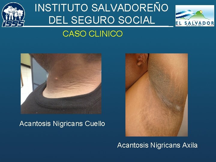 INSTITUTO SALVADOREÑO DEL SEGURO SOCIAL CASO CLINICO Acantosis Nigricans Cuello Acantosis Nigricans Axila 