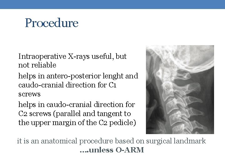 Procedure Intraoperative X-rays useful, but not reliable helps in antero-posterior lenght and caudo-cranial direction