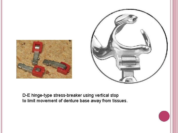 D-E hinge-type stress-breaker using vertical stop to limit movement of denture base away from