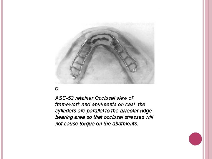 ASC-52 retainer Occlusal view of framework and abutments on cast: the cylinders are parallel