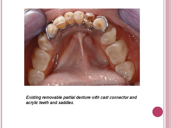 Existing removable partial denture with cast connector and acrylic teeth and saddles. 