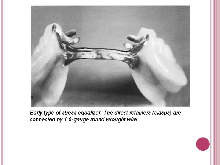 Early type of stress equalizer. The direct retainers (clasps) are connected by 1 6