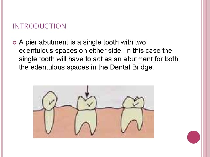 INTRODUCTION A pier abutment is a single tooth with two edentulous spaces on either