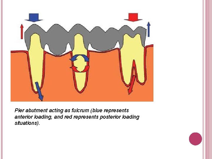Pier abutment acting as fulcrum (blue represents anterior loading, and represents posterior loading situations).