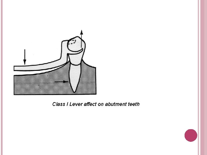 Class I Lever affect on abutment teeth 