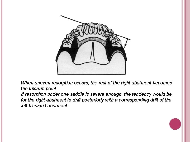 When uneven resorption occurs, the rest of the right abutment becomes the fulcrum point.