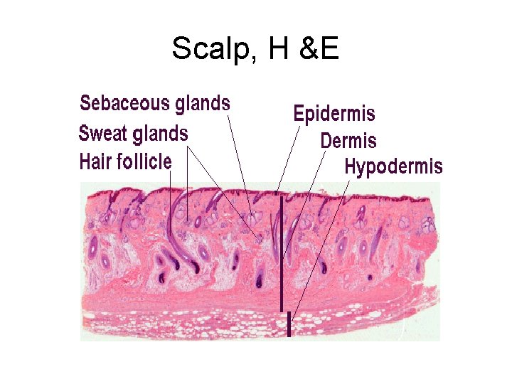 Scalp, H &E 
