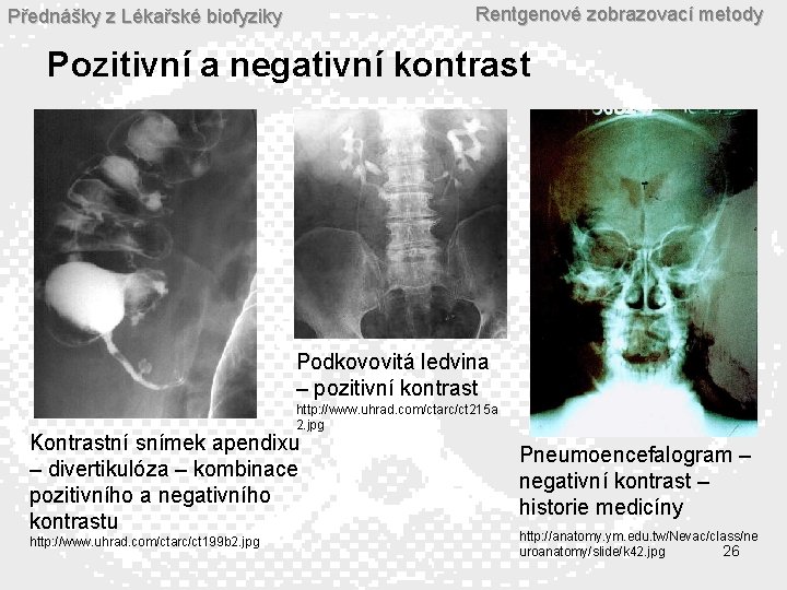 Rentgenové zobrazovací metody Přednášky z Lékařské biofyziky Pozitivní a negativní kontrast Podkovovitá ledvina –