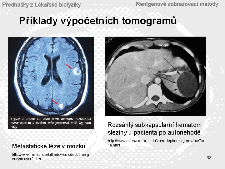 Přednášky z Lékařské biofyziky Rentgenové zobrazovací metody Příklady výpočetních tomogramů Rozsáhlý subkapsulární hematom sleziny