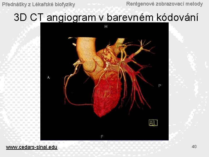 Přednášky z Lékařské biofyziky Rentgenové zobrazovací metody 3 D CT angiogram v barevném kódování