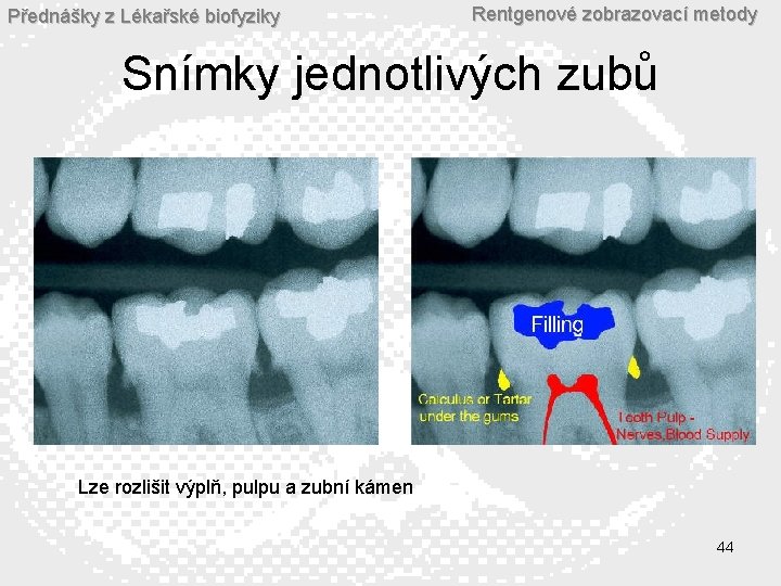 Přednášky z Lékařské biofyziky Rentgenové zobrazovací metody Snímky jednotlivých zubů Lze rozlišit výplň, pulpu