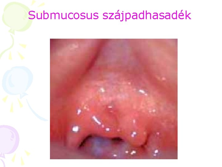 Submucosus szájpadhasadék 