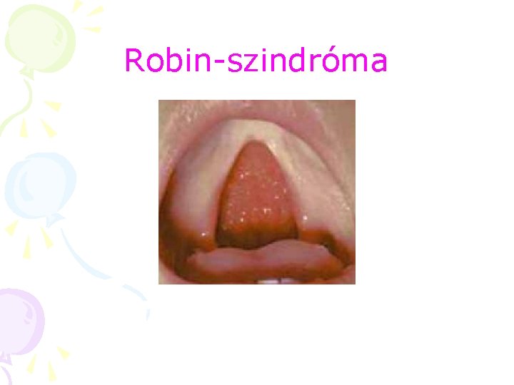 Robin-szindróma Robin-szindróma