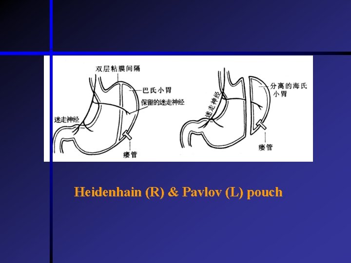 Heidenhain (R) & Pavlov (L) pouch  Heidenhain (R) & Pavlov (L) pouch