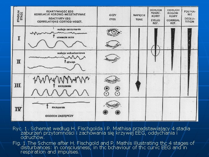 Ryc. 1. Schemat według H. Fischgolda i P. Mathisa przedstawiający 4 stadia zaburzeń przytomności